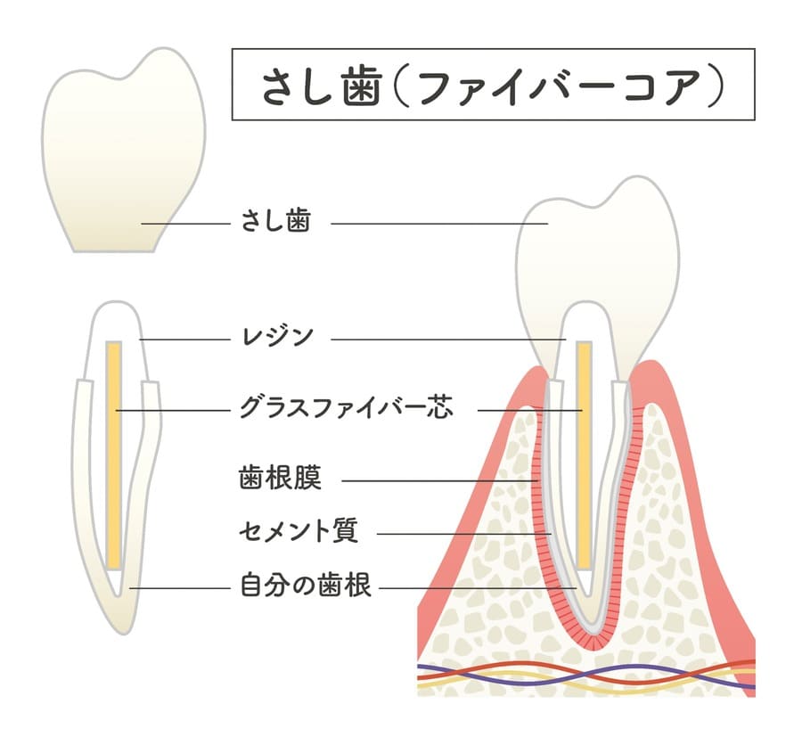 ファイバーコア(土台)