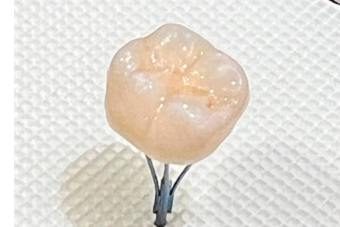 6:補綴物の完成