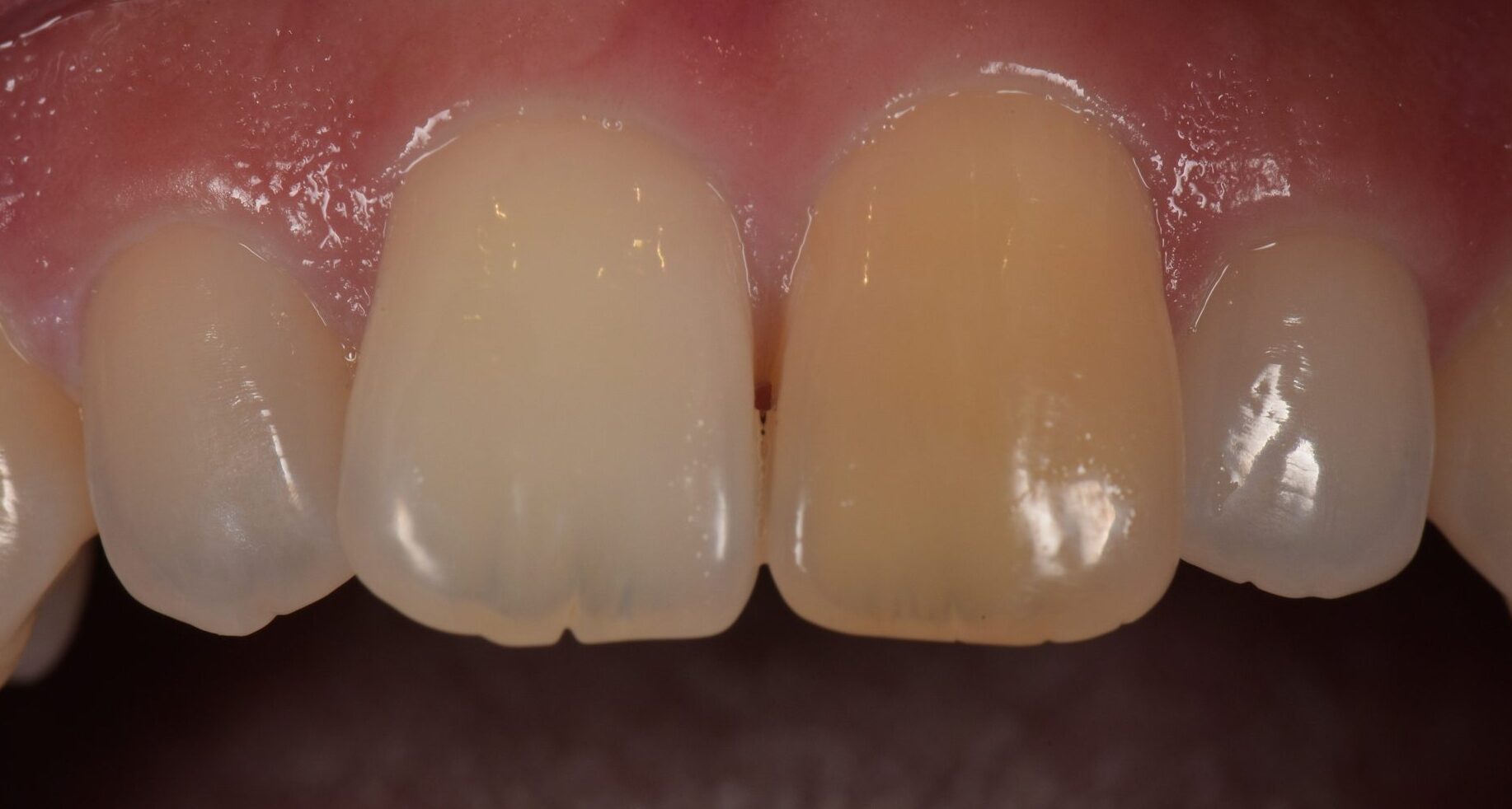 黄色い歯様 前歯の黄ばみをラミネートベニアで治療 | 診療案内 | 八幡山米山歯科